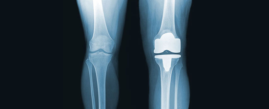 Joint & knee replacement illustration